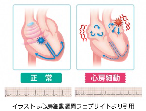 心房細動について